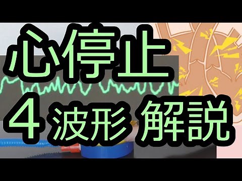 Explanation of the four types of cardiac arrest waveforms [ICLS, ACLS]