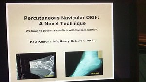 Percutaneous ORIF Navicular Fracture Banding Technique