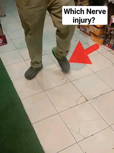 Foot Drop- Steppage Gait #mbbs