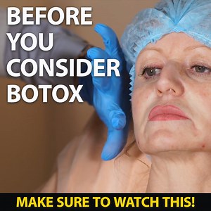 Before considering Botox see what Deep Wrinkle Filler can do for your skin 👉 https://bit.ly/39OWGme | Beverly Hills MD