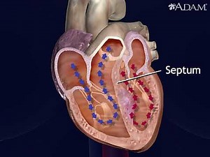 Hypertrophic Obstructive Cardiomyopathy Animation - Treatment Procedure for HOCM Video