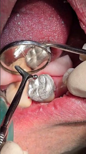 amalgam polishing