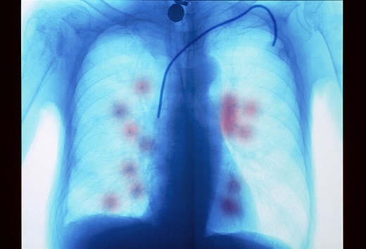 How Cancer Spreads to the Lungs and What It Means for the Patient