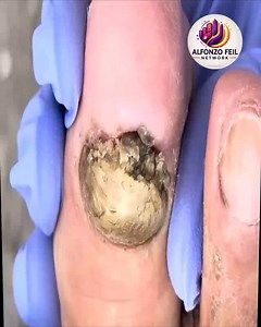 38K views · 233 reactions | Best Nail Practices for Cracked Toenails To Avoid Complications #footcare #trustedcare #gentlehealth | Alfonzo Feil | Facebook