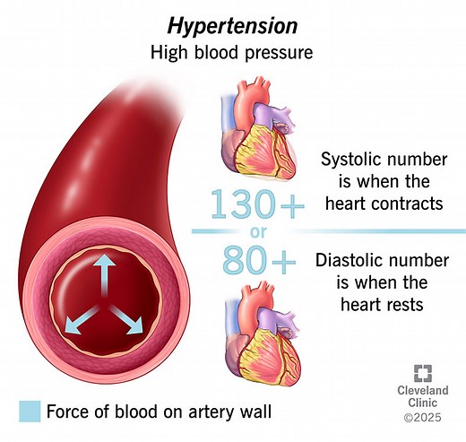 Why is Hypertension a Silent Killer?