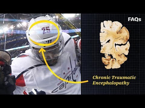 CTE: Why this brain disease is more common than you think