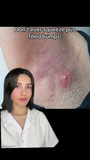 Popping a boil or a pimple may seem tempting, especially if they are painful or unsightly, but it's important to resist the urge to do so. Instead apply Beeswax and Propolis Magic salve that safely pulls out the inflammation, drains pus and further enhances skin regeneration. #mymagichealer #magicsalve #propolissalve #staph #staphylococcus #staphinfection #abscess #skininfection #infection #cyst #infectedskin #skinproblems #infectedcyst #skininflamation #eyestye | Mymagichealer