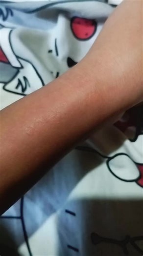 eraser method. Bru ts stings so bad.. || #vent #foryoupage