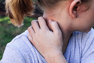 Eczema types: Atopic dermatitis symptoms