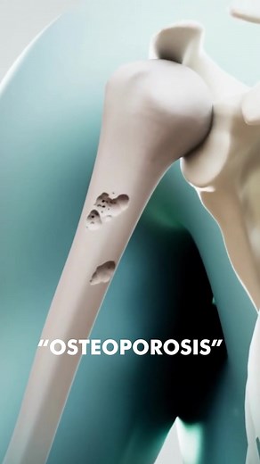 Understanding Osteoporosis: Causes, Symptoms, and Prevention