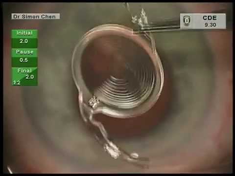 Tecnis Symfony intraocular lens (IOL) implant & femtosecond laser cataract surgery - Dr Simon Chen