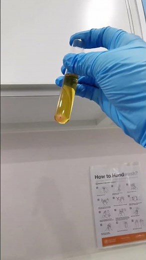 amorphous urates crystals in urine under the microscope #laboratory
