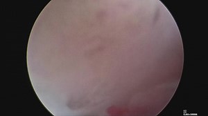 Hysteroscopic shaving of the endometrium using Bugatti Shaver by Karl...