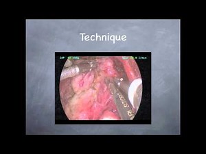 Minimally Invasive Endoscopic Thyroidectomy