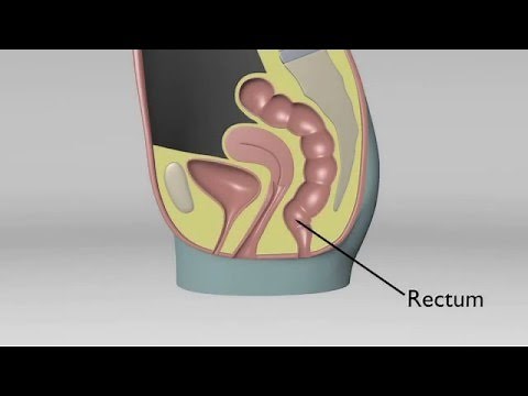 Rectocele