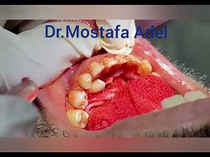 Mandibular impacted canine surgical extraction.