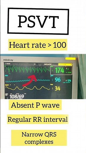 psvt reversal with adenosine | supraventricular tachycardia | arrhythmias| heart #ecg #shorts