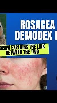 Dermatologist explains: Rosacea and the link with Demodex Mites: What can be done? #Rosacea #demodex