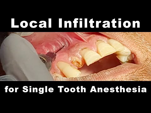 Local Infiltration - Single Tooth Anesthesia