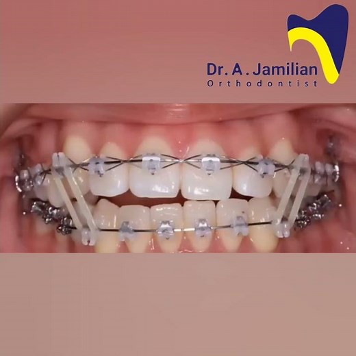 Straightening and Aligning Teeth with Fixed Orthodontics #orthodontics #aligning #straightening