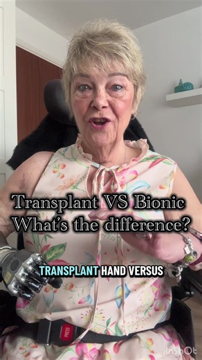 Transplant VS Bionic What's the difference? #bionichand #prosthetic #handtransplant #sepsisawareness
