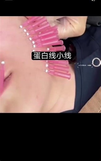 PDO spiral threads for facial filling, firming and lifting