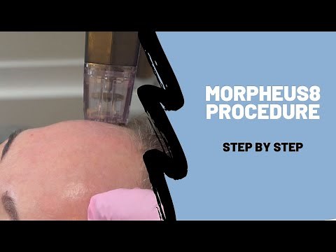 Morpheus8 - Step by Step Procedure Breakdown