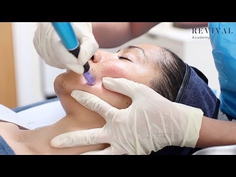 Micro-needling Full Training Video