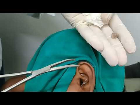 Sebaceous Cyst Removal