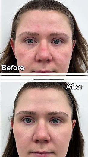Botox Before and After: Stunning Results You Won’t Believe!