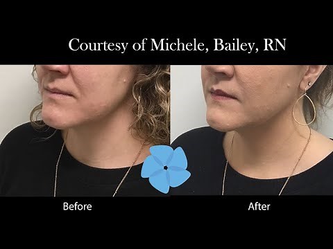 Filler for Nasolabial Folds | Nashville Injector