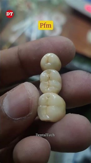 Posterior Ceramic bridge| ceramic| porcelain| build up video| anterior| lab video| dental video| lab