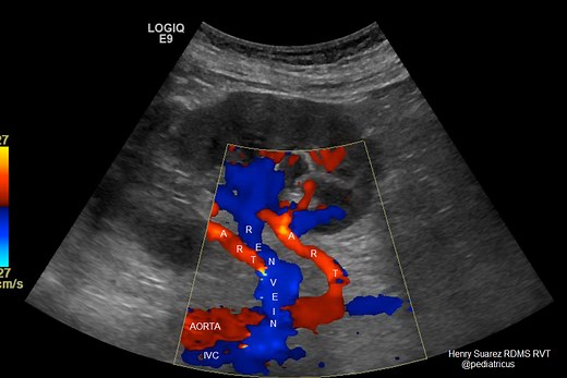 Renal Artery Doppler