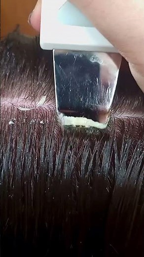 Scalp Treatment for Severely Dry Scalp