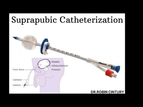 A Suprapubic Catheterization,Procedure.Live video.