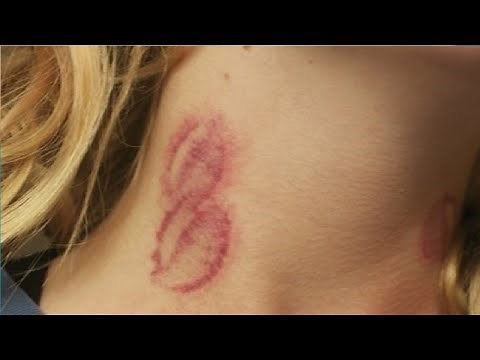 how to give someone a hickey easiest method