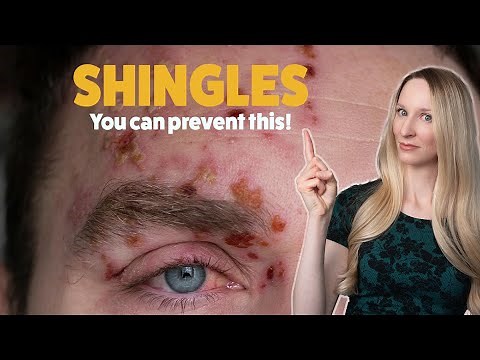 Dermatologist Complete Guide to Shingles That Will Save Your Health!
