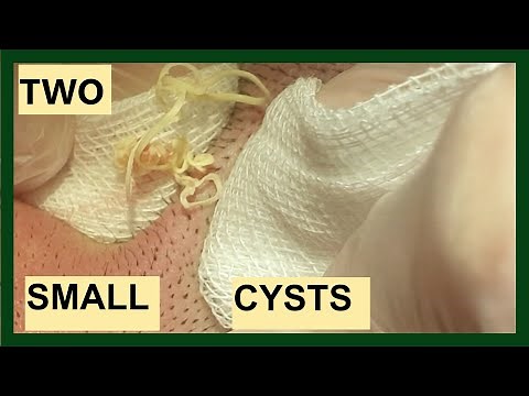 CYSTS REMOVAL - (With CAPSULES)