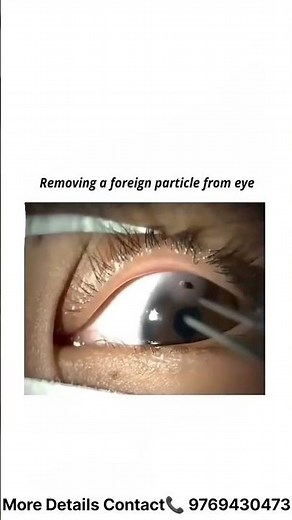 How to Safely Remove a Foreign Object from the Eye | Ophthalmologist Explains #eyesafe#eyehealth