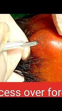 abscess over forehead | infected cyst over forehead | incision n drainage #youtube #dr #doctor