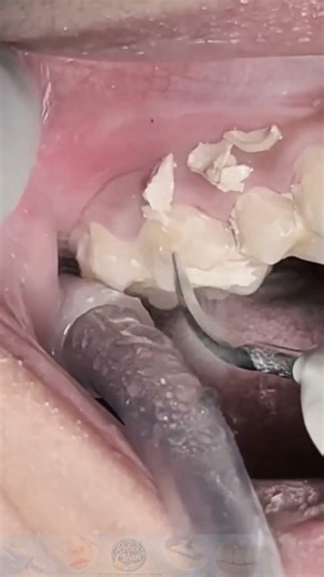 From Yellow to Brilliant White: Intense Scaling Process 😁 #DentalCleaning #TeethScaling #OralHealth