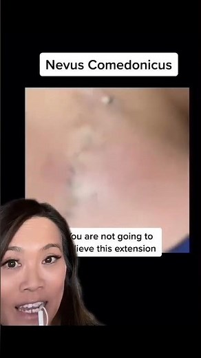 It's good luck if you know someone with a nevus comedonicus 🍀 ⁠