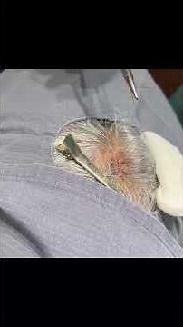 A sweet little Pilar Cyst on the scalp!