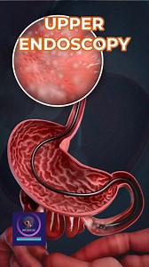 98K views · 625 reactions | Upper Endoscopy EGD – How to Prepare for an Upper Endoscopy Test#UpperEndoscopy #EGDProcedure #EndoscopyPreparation #GastroHealth #DigestiveHealth #EGDTest #GIEndoscopy #StomachHealth #MedicalProcedure #AcidReflux #UlcerDiagnosis #EndoscopyGuide #foryou #medicalanimation | Medical Animation Media | Facebook