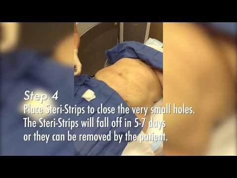 Smart Lipo on the Upper and Lower Abs