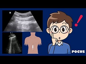 A- and B-lines on abdominal ultrasound: POCUS pearls - Dr. Koratala (@NephroP)