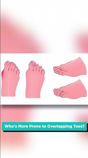Overlapping Toes: Causes and Solutions #shorts