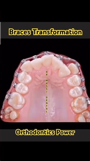 BRACES Transformation power