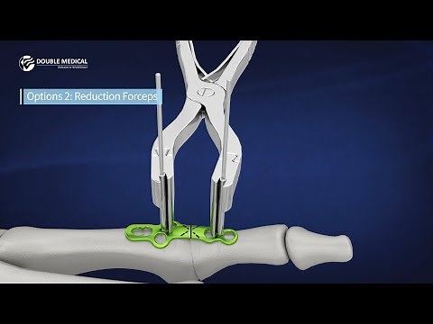 MTP Fusion Surgical Technique Animations (3 surgical Options) Double Medical Marathon Fusion System