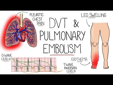 Deep Vein Thrombosis (DVT) & Pulmonary Embolism Explained
